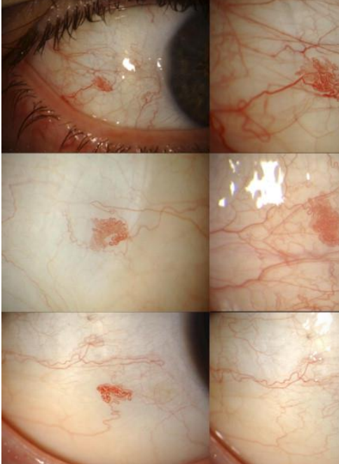 <ol><li><p>•<strong><u> Sessile/immobile,</u></strong> flat lesion with c<strong><u>onvoluted intertwining blood vessels </u></strong></p></li><li><p>• Often smaller in size </p></li><li><p>• Often<strong><u> remain stable in size without growth</u></strong></p></li></ol><p></p>