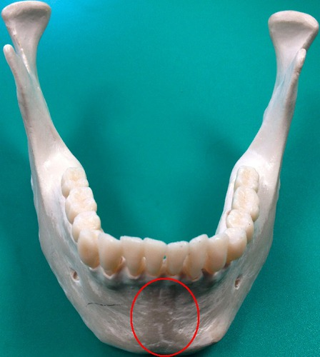 <p>Anterior median depression indicating point of mandibular fusion</p>