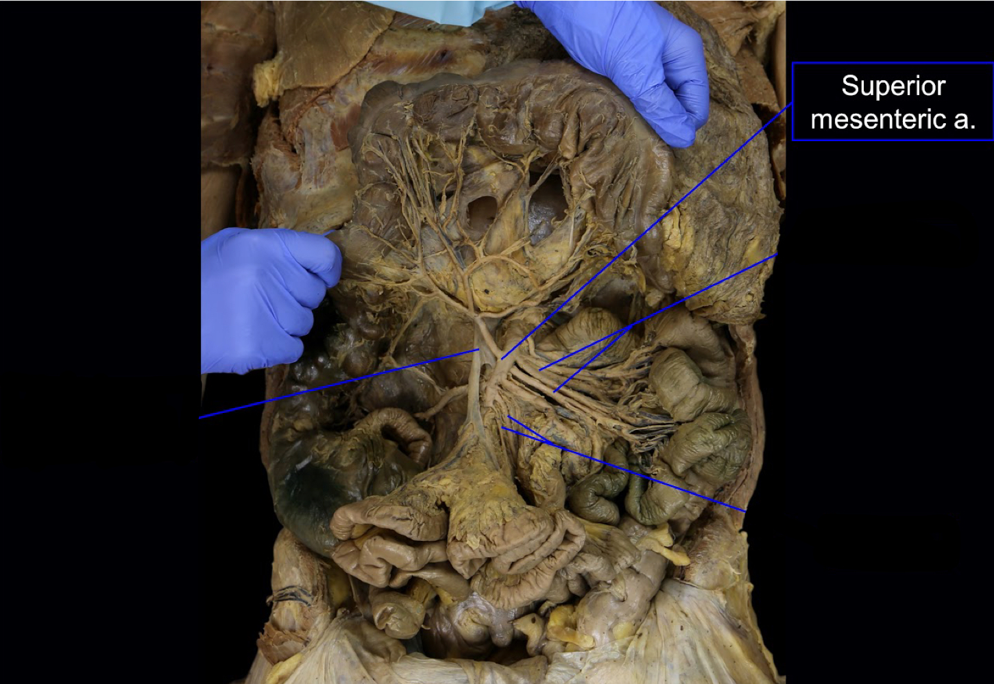 <p>abdominal aorta<br>(highlighted: superior mesenteric artery)</p>