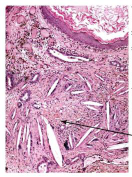 <p>Cholesteatoma of middle ear</p><p>M/P:</p><p>Cyst filled with abundant keratin + cholesterol clefts + large number of histiocytes.</p>