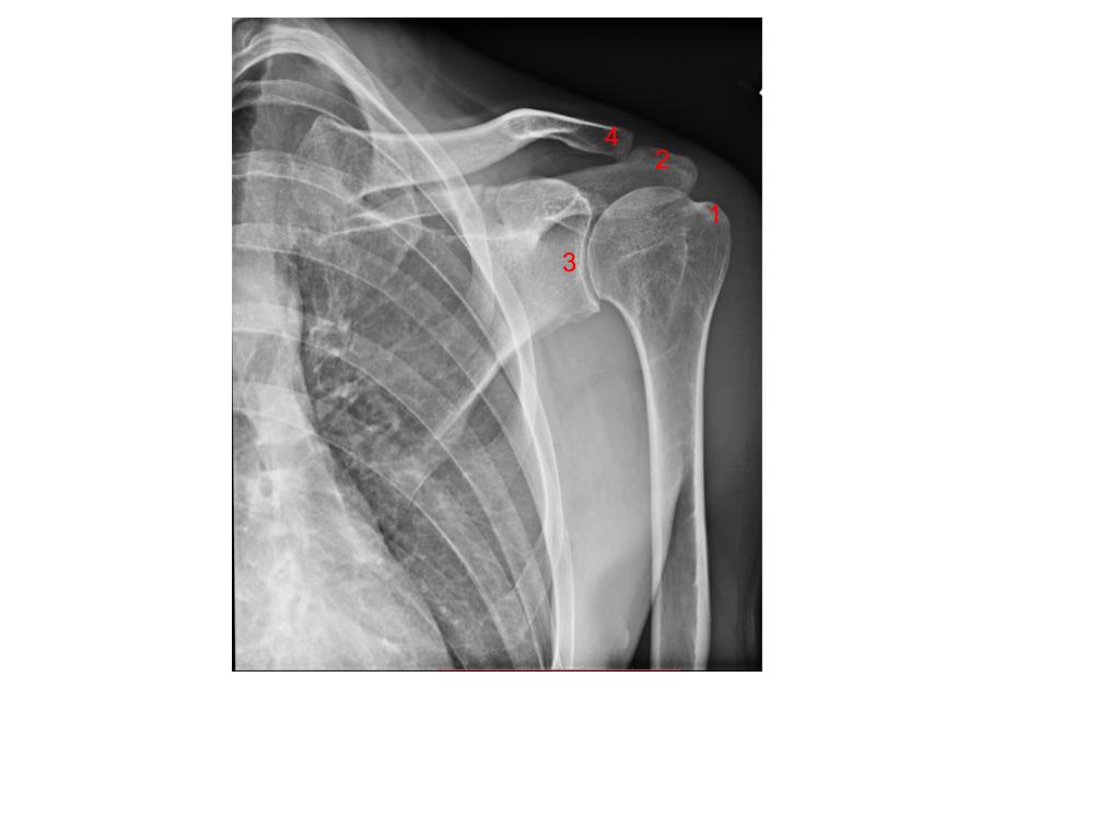 <p>What structure is #3?</p><p>A. Greater tubercle</p><p>B. Clavicle</p><p>C. Acromion process</p><p>D. Glenoid process</p>