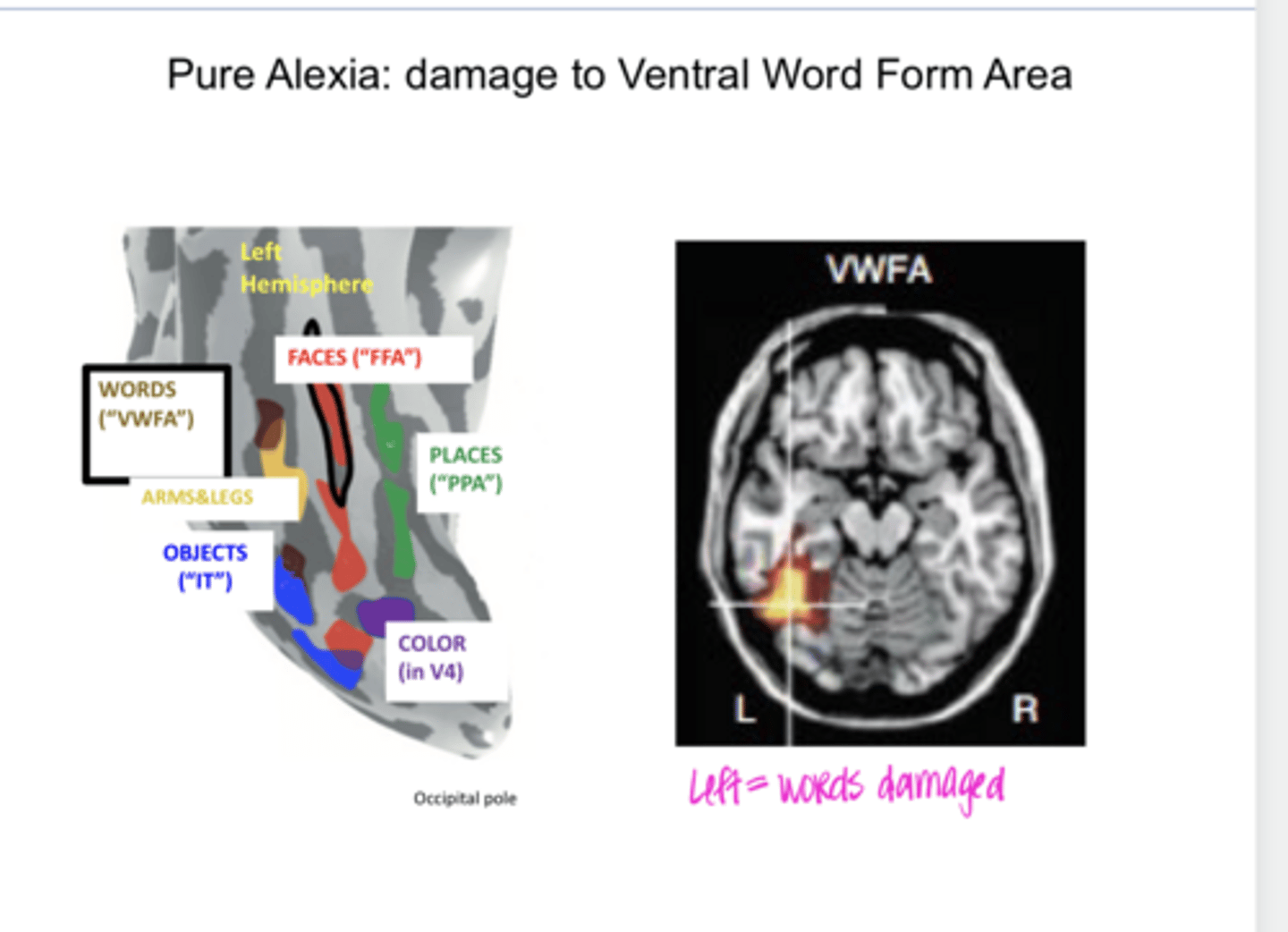 <p>What is pure alexia d/t? Damage in what region of the brain?</p>