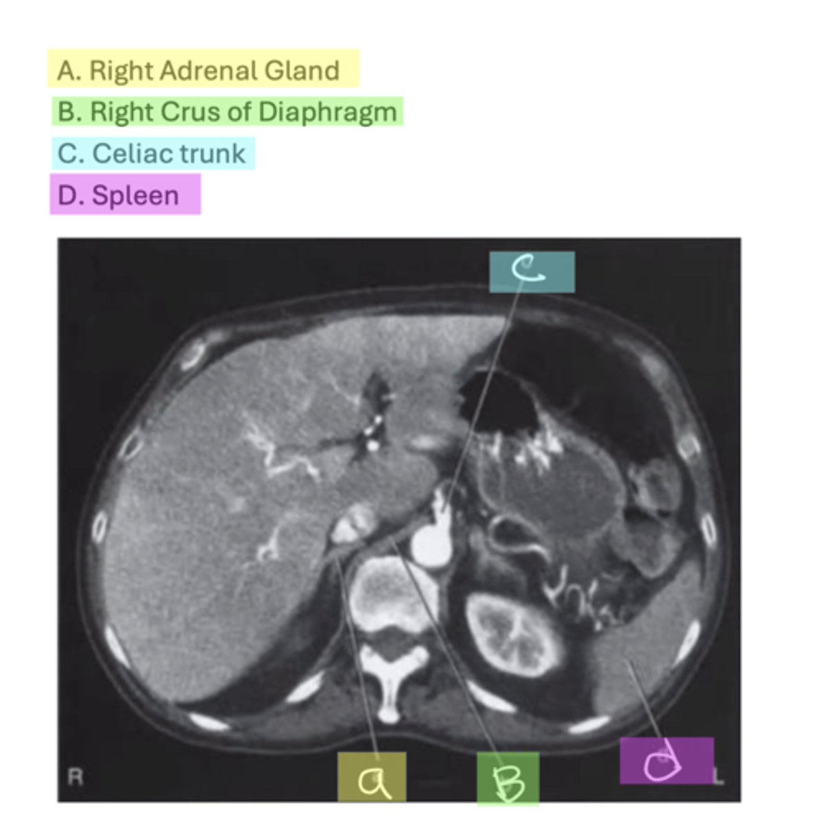 <p>A. Right Adrenal Gland</p><p>B. Right Crus of Diaphragm</p><p>C. Celiac trunk</p><p>D. Spleen</p>