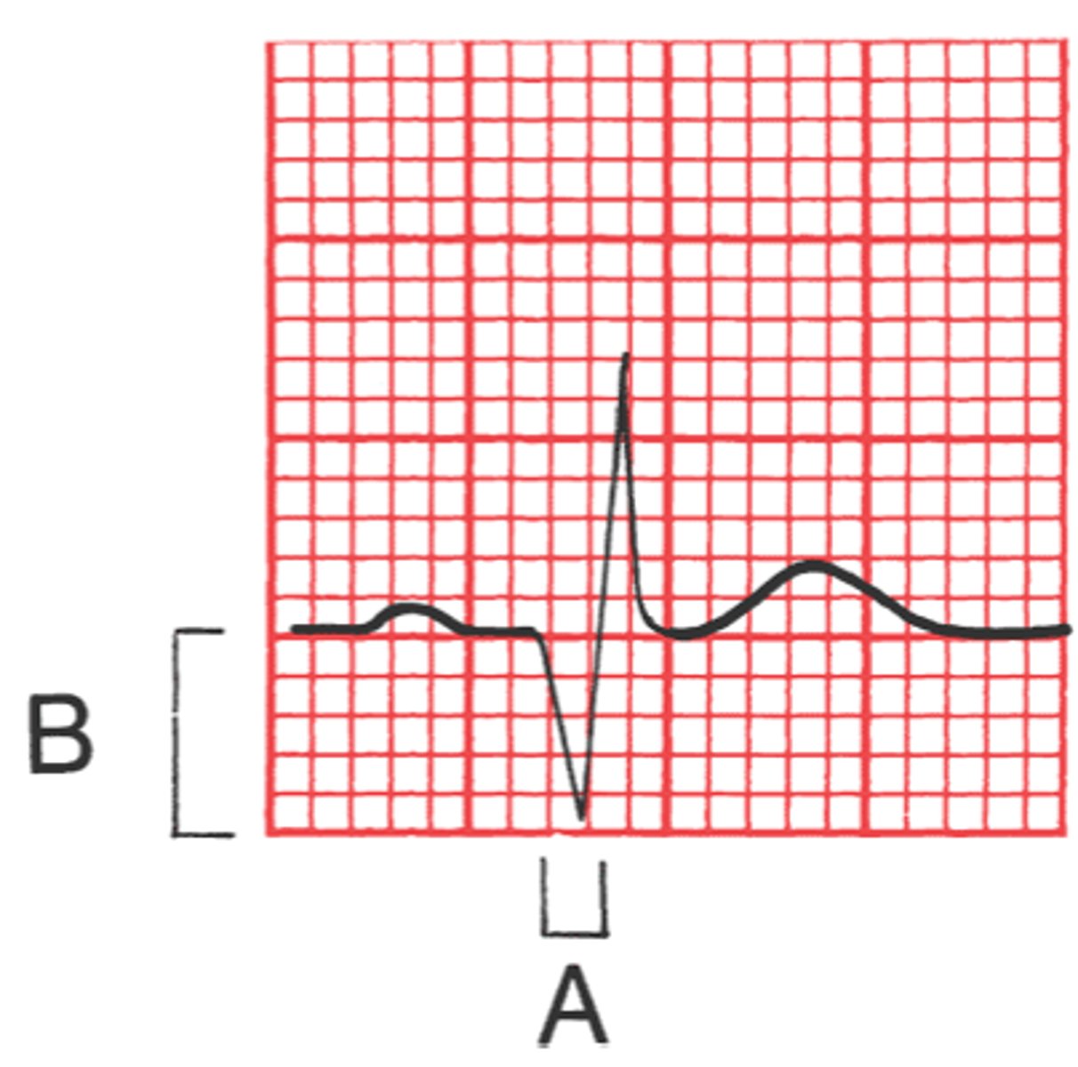 <p>normal sinus rhythm</p>