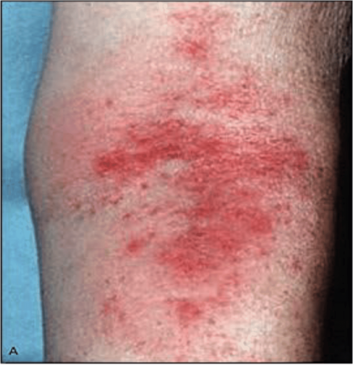 <p>dx: atopic dermatitis (aka eczema)</p><p>tx: topical corticosteroids + antihistamines for itching w/ daily application of non-scented lotions/emollients and switching to gentle detergent, topical calcineurin inhibitors another option (tacrolimus, pimecrolimus alternative to steroids but can cause irritation and possible lymphoma/skin cancer risk)</p>