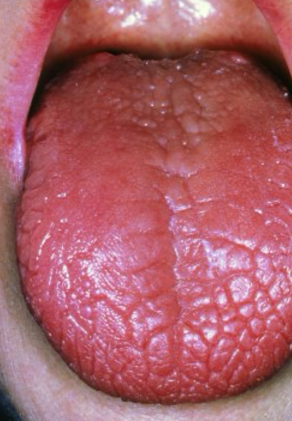 <p>• Maladie auto-immune provoquant une sécheresse des muqueuses (oculaire, buccale, cutanée…)<br />
• Diagnostic par biopsie des glandes labiales</p>