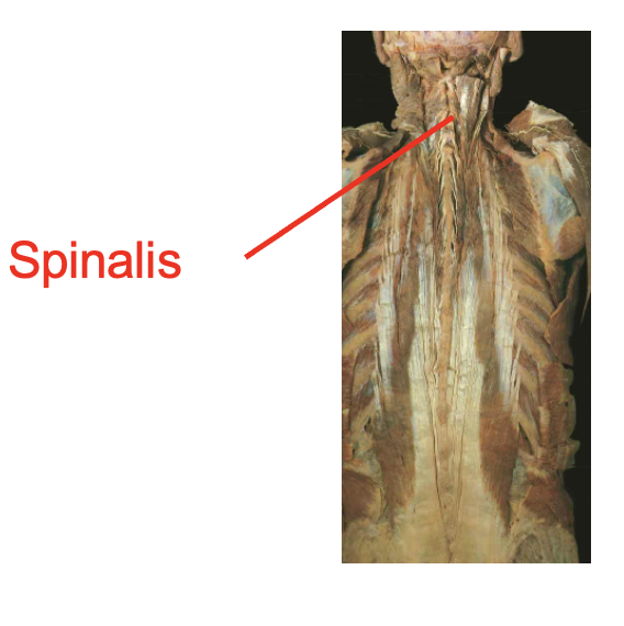 <p>spinalis (notes runs along the spineal area).</p><p></p><p>Origin</p><ul><li><p>ligamentum nuchae</p></li><li><p>spinous process of cervical thoractic and lumbar vertibrea</p></li></ul><p>Insertion</p><ul><li><p>occipital bone</p></li><li><p>spinous process of cervical and thoractic verterael column</p></li></ul><p></p><img src="https://knowt-user-attachments.s3.amazonaws.com/74874f95-8600-4ace-afd7-4fe9971307d6.png" data-width="100%" data-align="center"><p></p>