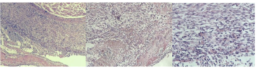 <p><strong>Pleuritis fibrosa</strong> (Repair by organization)</p><p><em>Extra note: Importance of this mechanism (repair by organization) is such that </em><span style="color: blue;"><em>the area does not return to normal, but remains in a scarred state,</em></span><em> so that the organ or tissue involved is permanently damaged and may be functionally impaired (defect). </em></p><p><em>Granulation tissue grows into the fibrous exudate to liquify and engulf it (repair process). This pathological process leads to adherence of the parietal and visceral layers. From the bottom: mature fibrous CT → granulation tissue → fibrous exudate (neutrophils) in picture.</em></p>