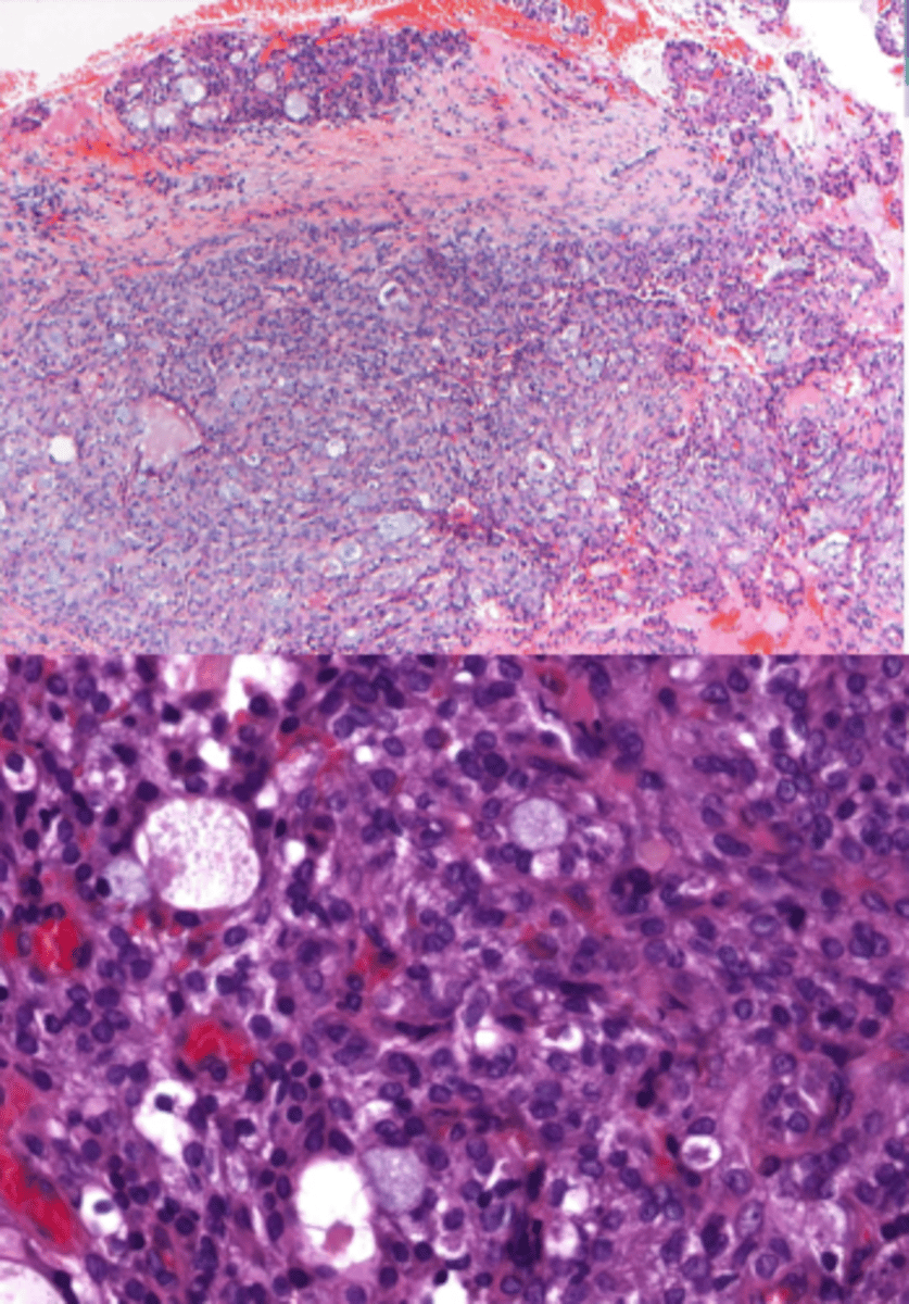<p>-Epidermoid cells</p><p>-Mucous cells</p><p>-Ductal structures</p><p>-Cystic spaces</p><p>-CRCT1-MAMl2 translocation ⇒ t(11;19)</p>