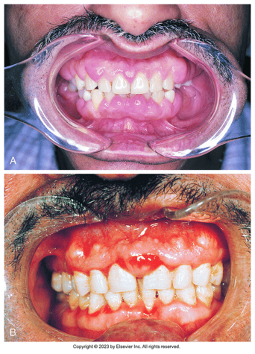 <p>Gingival enlargement; Increase in the bulk of free & attached gingiva, especially the interdental papillae</p>