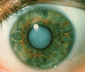 <p>Clouding of the lens</p>