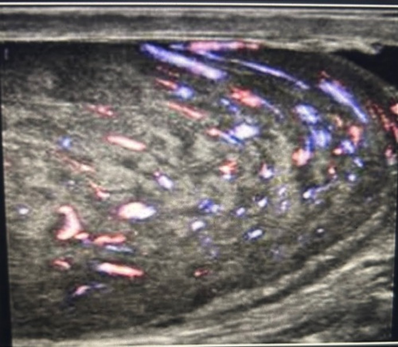 <p>Seminoma</p><p>Note the lab results in the internal vascularity of the mass. AFP levels are always normal in cases of seminoma, but the bhCG can be elevated. Most seminomatous tumors over 1.6 cm demonstrate hypervascularity. Embryo cell cancer usually is associated with increased levels of bhCG, and AFP. A yolk sac tumor usually associated with increased levels of AFP. And epidermoid cyst would not demonstrate internal vascularity.</p>