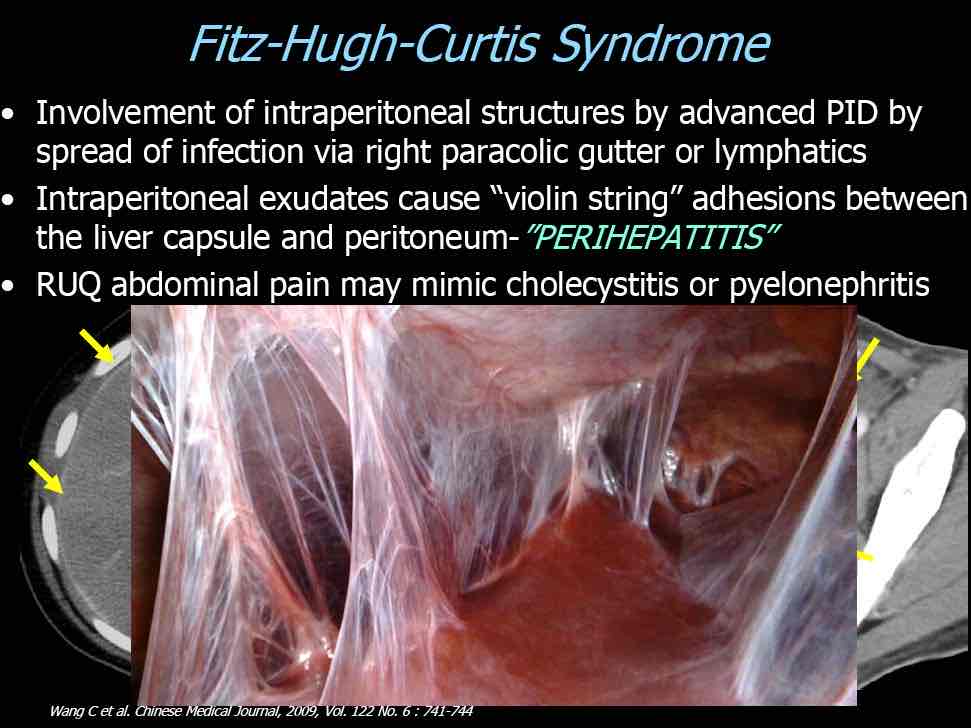 <p>What is the MOST likely etiology for right upper quadrant pain in a patient with PID?</p>