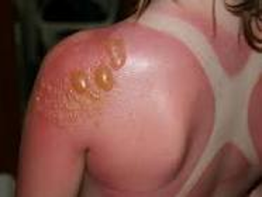<p>1st degree burn-Causes</p>