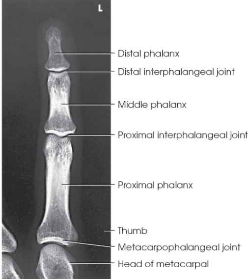 <ol><li><p>Equal concavity on both sides of the phalangeal bodies</p></li><li><p>Equal amount of soft tissue on both sides of phalanges</p></li><li><p>If fingernails are seen, centered over the distal phalanx</p></li></ol>