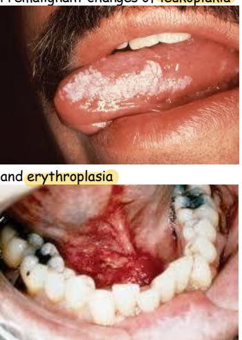 <ol><li><p>leukoplakia </p></li><li><p>erythroplasia</p></li><li><p>chronic, non-healing painless ulcer </p></li></ol><p></p>