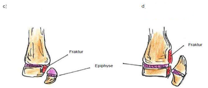 <p>Epiphysen(Wachtumszonen)fraktuen nach Aitken - körperferne Tibia (Schienbein)</p>