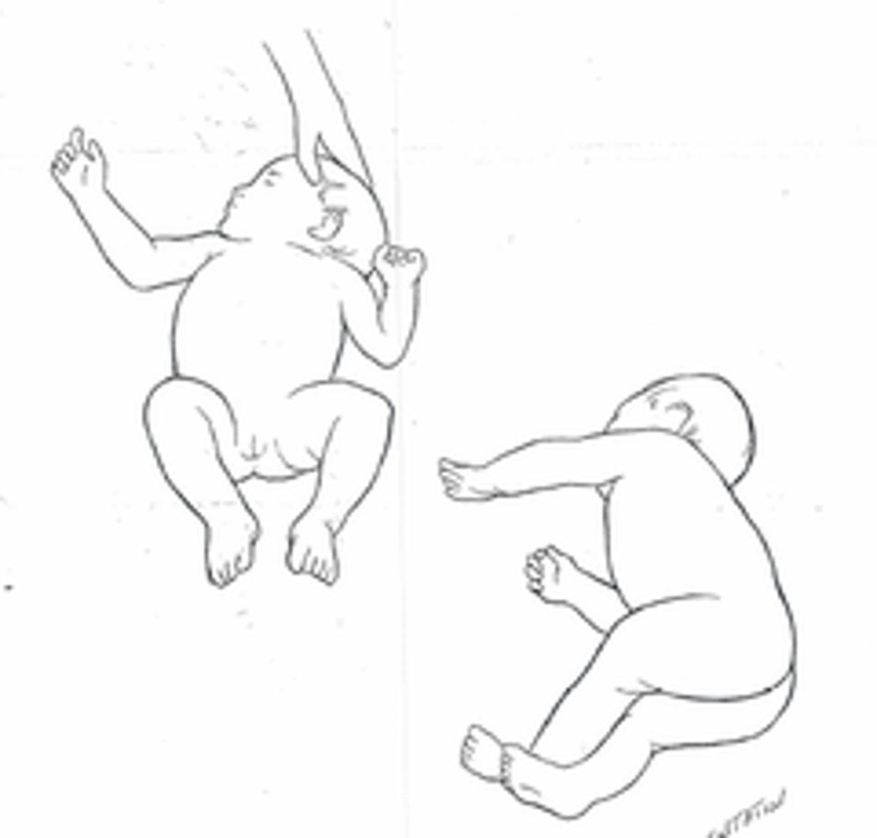 <p>turn head of infant in supine</p><p>body turns toward head</p><p>- onset 34 weeks, integrates 4-6 months</p>