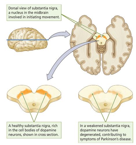 <p>The substantia nigra, a nucleus in the midbrain involved in initiating movement.</p><ul><li><p>A healthy substantia nigra = rich in the cell bodies of dopamine neurons.</p></li><li><p>A weakened substantia nigra = dopamine neurons have degenerated, contributing to symptoms of Parkinson’s disease. </p></li></ul><p></p>