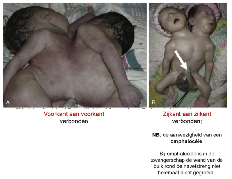 <ul><li><p>in zeldzame gevallen kunnen zulke tweelingen niet volledig van elkaar scheiden</p><p>→ resulteert in geboorte van Siamese tweelingen</p></li><li><p>Siamese tweelingen ontstaan wanneer splitsing van een bevruchte eicel niet volledig plaatsvindt</p><ul><li><p>splitsing gebeurt meestal tussen 13e &amp; 15e dag na bevruchting → als splitsing later dan dit tijdstip plaatsvindt, kan dit resulteren in Siamese tweelingen</p></li></ul></li></ul><p></p>