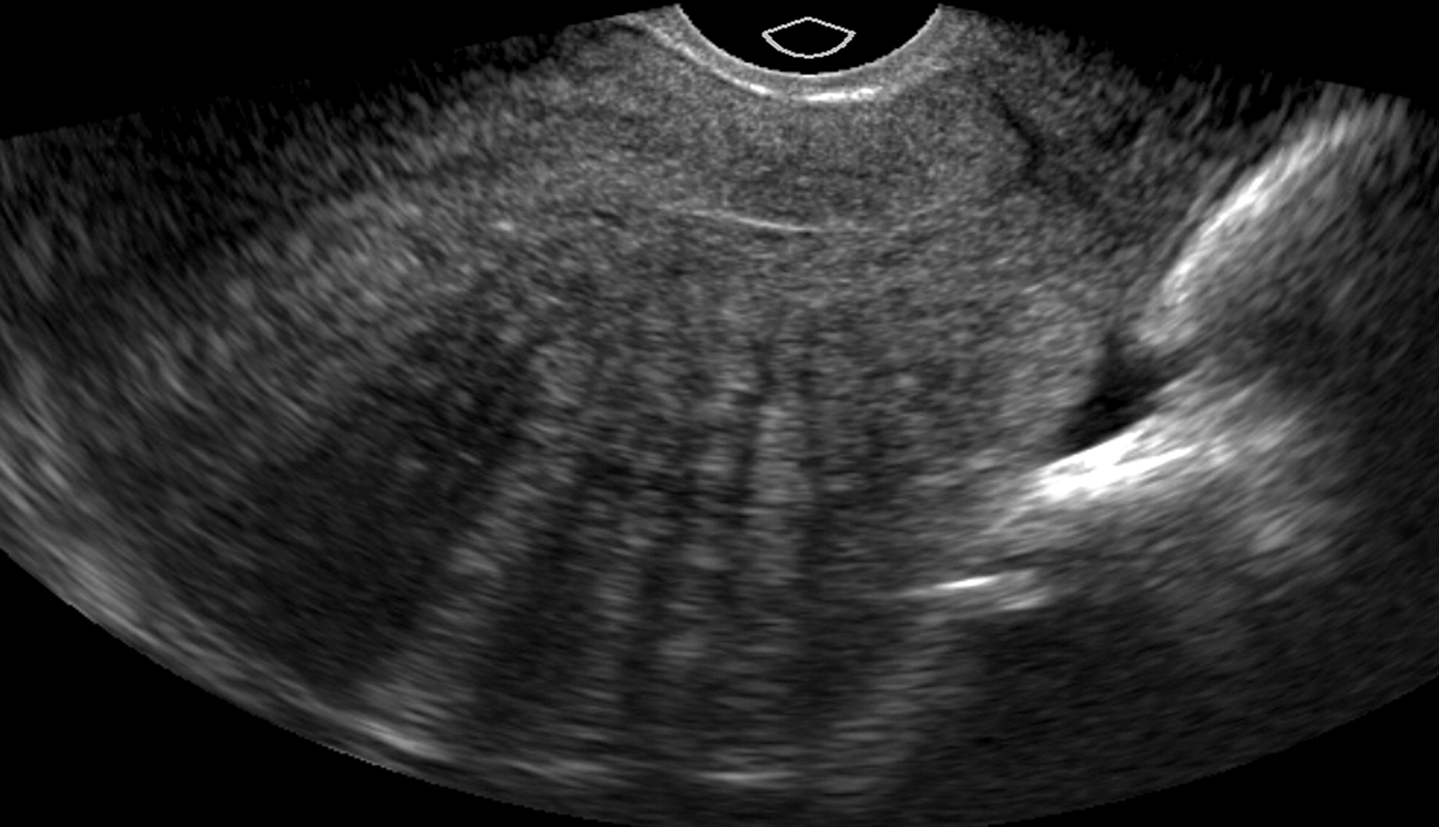 <ul><li><p>form of endometriosis<strong> (WITHIN MYOMETRIUM)</strong></p></li><li><p>benign, ectopic occurrence of endometrial tissue invasion</p></li><li><p>OLDER WOMEN</p></li><li><p>MULTIPARIOUS</p><ul><li><p>heavy, painful periods</p></li><li><p>tenderness</p></li><li><p>Hypermenorrhea (heavy bleeding)</p></li><li><p>metorrhea (irregular bleeding)</p></li></ul></li></ul><p></p>