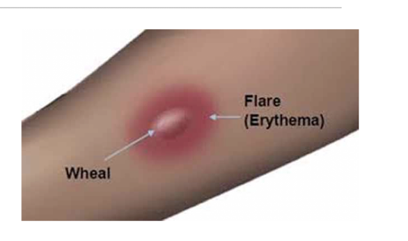 <p>Histamine effects</p><ol><li><p>Flush/red spot - vasodilation of local caps</p></li><li><p>Flare - vasodilation of arterioles = wider reddened area</p></li><li><p>Wheal - localized edema results from increased cap permeability</p></li></ol><p></p>