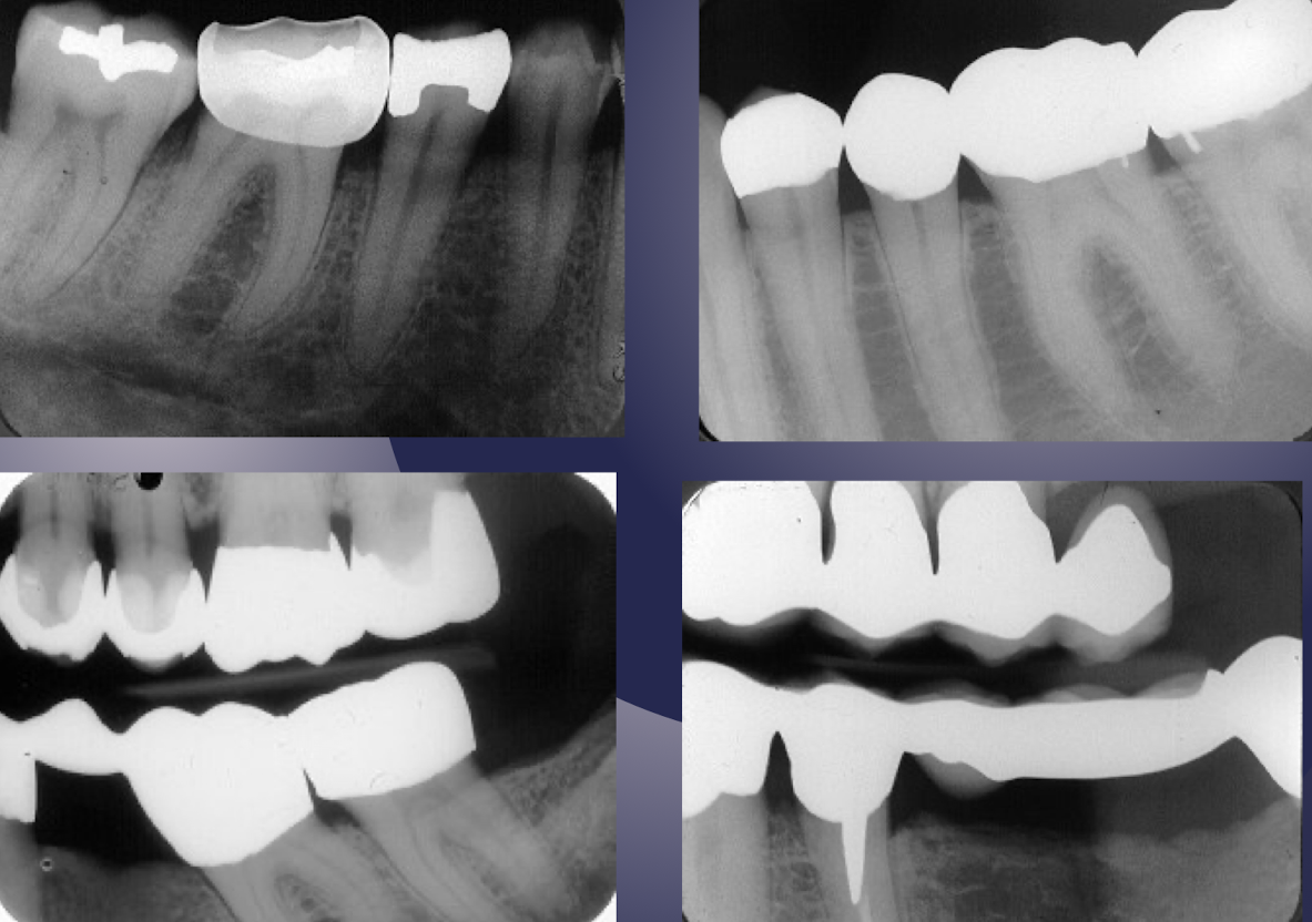 <p>which restorative material?</p>