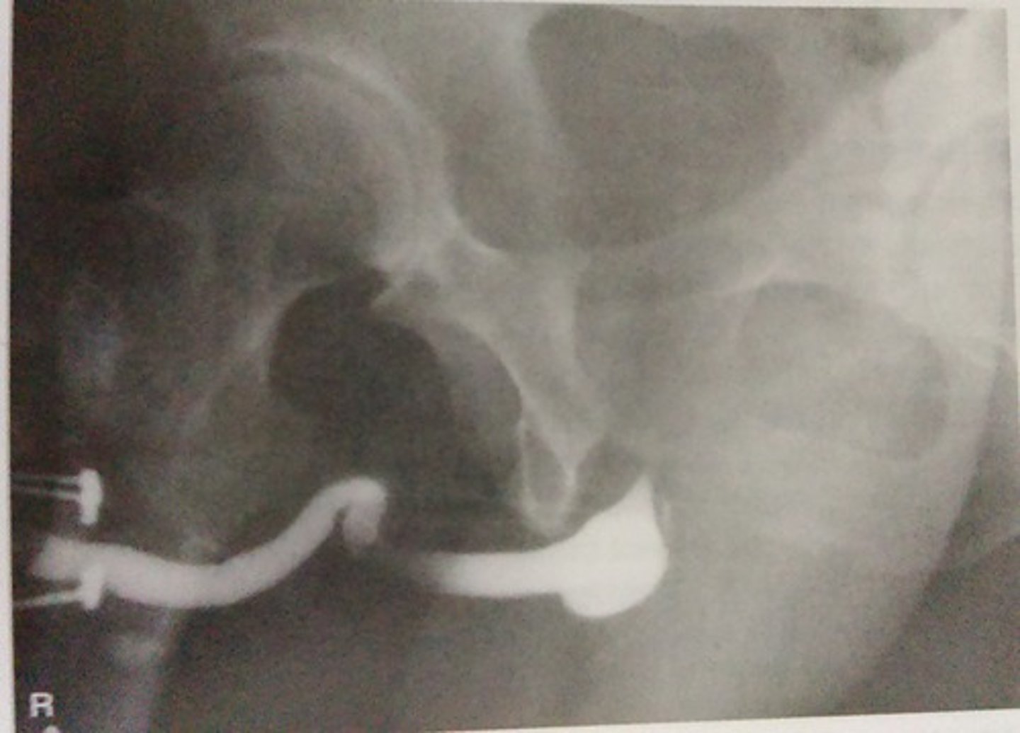 <p>urethral rupture refers to a complete tear of the urethra, often due to trauma</p><p>- anterior is seen with straddle injury</p><p>- posterior is caused by a pelvic fracture showing signs of urine leaks into retropubic space on urethrogram</p>