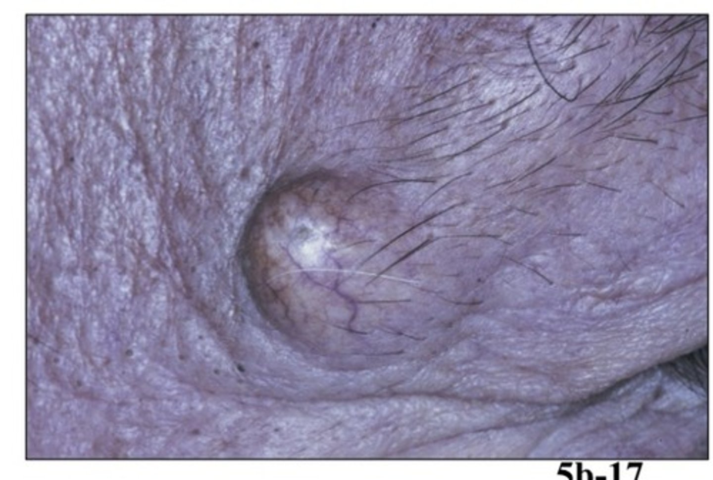 <p>- cause: arises from epithelium of hair follicles</p><p>- population: any</p><p>- clinical features: movable fluctant nodule, yellowis/white or normal skin appearance</p>