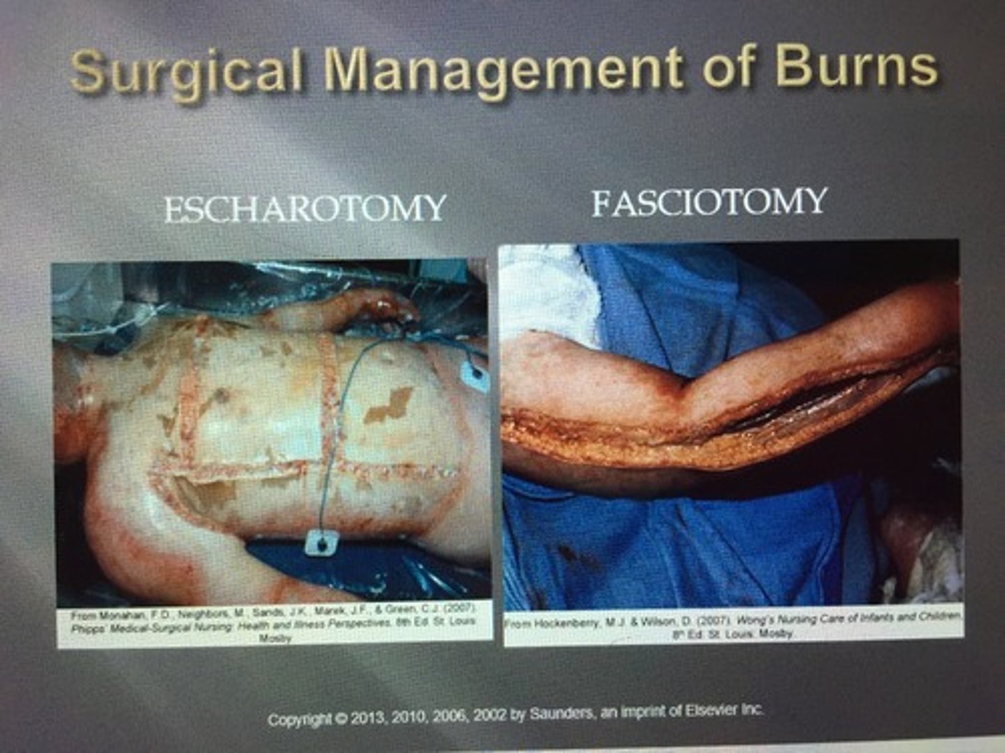 <p>A surgical incision through the fascia to relieve tension or pressure.</p><p>Incision through skin, fat and muscle fascia, exposing the underlying muscle compartment.</p>