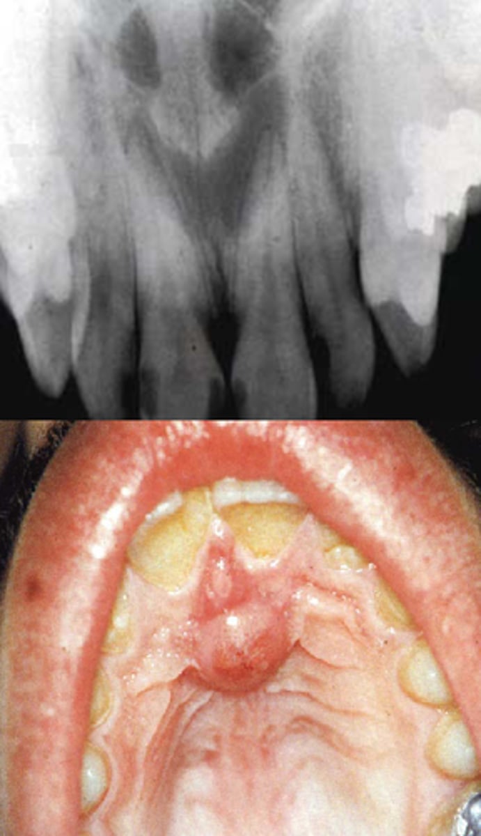 <p>nasopalatine canal/papilla</p>