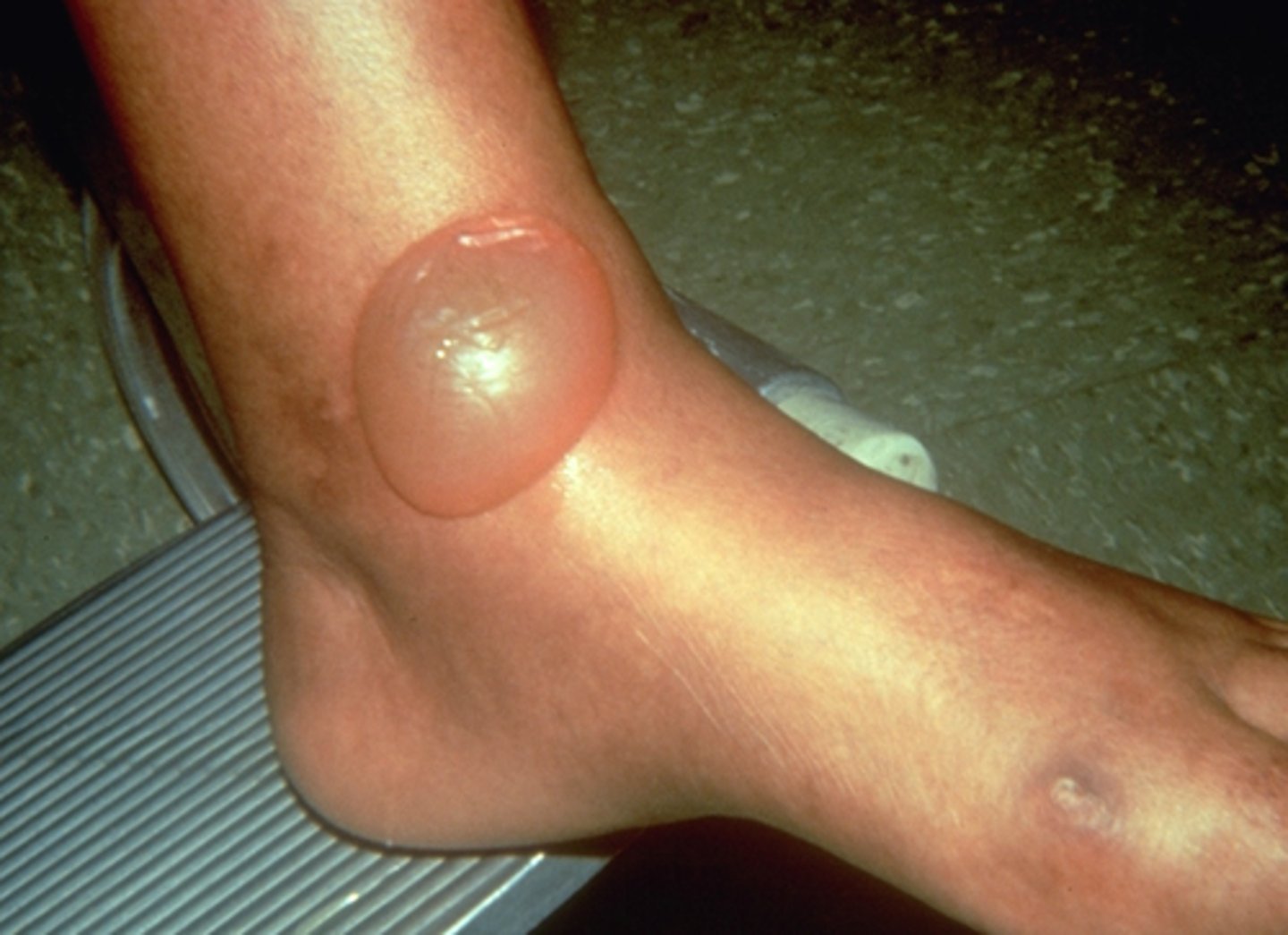 <p>Diabetic blisters that may develop secondary to DM</p>
