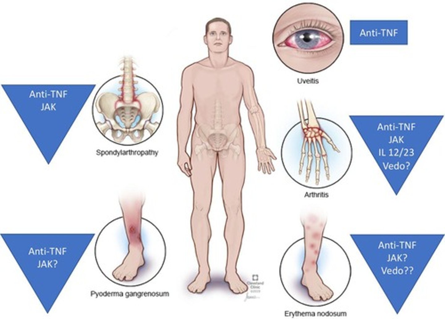 <p>Low back inflammation, arthritis, eye issues, rashes, and autoimmune liver disease.</p>