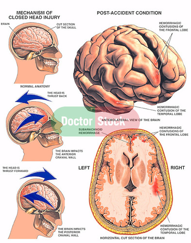 A brain dysfunction caused by an outside force to the head.