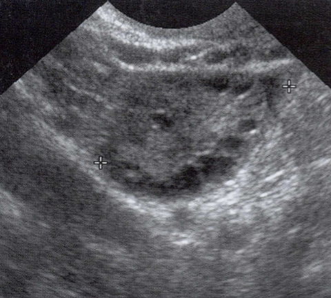 <ul><li><p>May appear as enlarged ovaries</p></li><li><p>Follicles located in the <span style="color: #0076ff">periphery</span></p></li><li><p><span style="color: #ff0000">“String of Peals” sign</span></p></li><li><p>Increased risk of<strong> ovarian torsion</strong></p></li></ul><p></p>