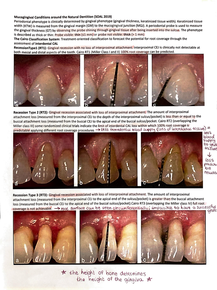 <ul><li><p><strong>Cairo Classification System:</strong> treatment-oriented classification to forecast the potential for root coverage throughout the assessment of <strong>interdental CAL</strong></p><ul><li><p><strong>RecessionType1 (RT1):</strong> recession with <strong>NO loss of interprox. attachment</strong></p><ul><li><p>CEJ is not clinically detectable at mesial/distal aspects</p></li><li><p>100% root coverage can be predicted</p></li></ul></li><li><p><strong>RecessionType2 (RT2):</strong> recession WITH loss of interprox. attachment</p><ul><li><p><strong>interprox attachment loss is ≤ buccal attachment loss</strong></p></li><li><p>some clinical trials indicate the limit of interdental CAL loss within which 100% root coverage is predictable using root coverage procedures</p></li></ul></li><li><p><strong>RecessionType3 (RT3): </strong>recession WITH loss of interprox. attachment;</p><ul><li><p><strong>interprox attachment loss is > buccal attachment loss</strong></p></li><li><p>full root coverage is <strong>NOT </strong>achievable</p></li></ul></li></ul></li></ul><p></p>