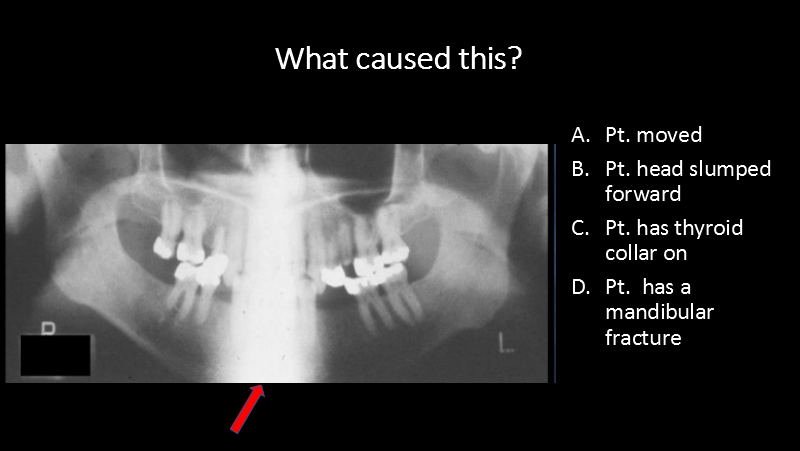 <p>What caused this?</p><p>A. Pt. moved</p><p>B. Pt. head slumped forward</p><p>C. Pt. has thyroid collar on</p><p>D. Pt.  has a mandibular fracture</p>