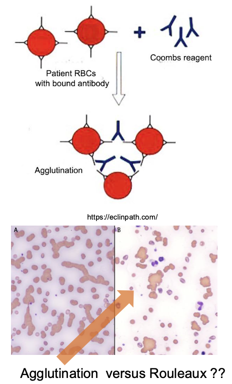 <p>-flow cytometry for RBC surface antibodies (good sensitivity)</p><p>-saline agglutination test (false negative common)</p><p>-direct coomb's test (positive=Ab present on RBC membrane; false negatives common)</p>