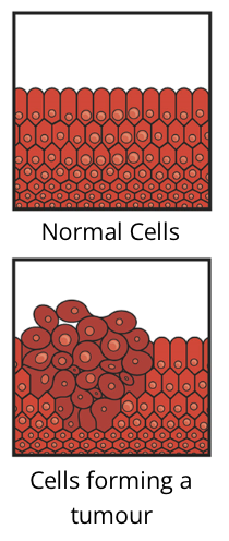 <p>benign tumour</p><ul><li><p>not cancerous</p></li><li><p>unable to grow indefinitely or invade surrounding tissues</p></li></ul><p>malignant tumour</p><ul><li><p>cancerous</p></li><li><p>ability to metastasize </p></li><li><p>continuous growth</p></li></ul><p></p>