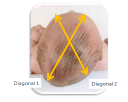 <p><em>Diagonal 1</em> - right anterior quadrant to left posterior quadrant </p><p><em>Diagonal 2</em> - left anterior quadrant to right posterior quadrant </p><p><strong>30 degrees off of midline </strong></p><p><strong>TDD = D1-D2</strong></p><p>Tool - M/L Caliper </p>