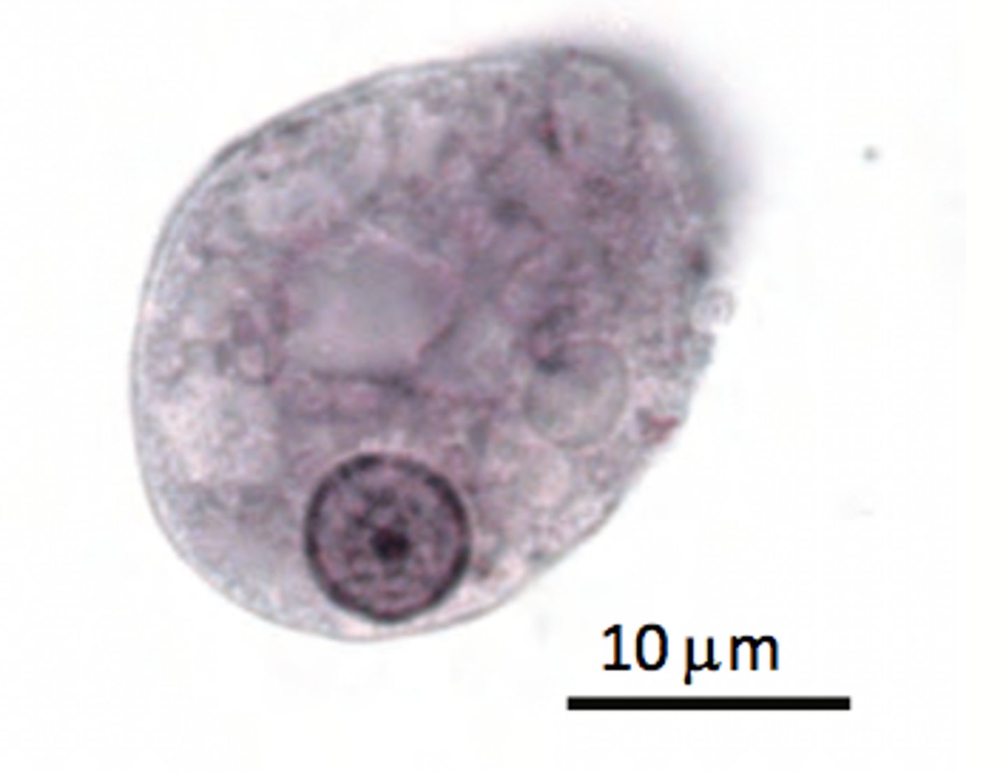 <p>AMOEBIC DYSENTERY GI INFECTION --> invades lining of colon and forms ulcers</p>