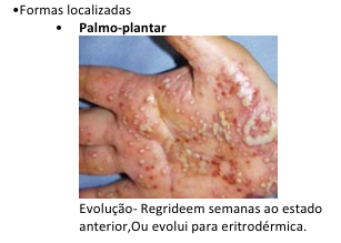 <p>psoriase pustulosa</p><p>• Gatilhos: </p><p>• Interrrupçãode corticóide sistêmico, </p><p>• Infecções </p><p>• Hipocalcemia;</p>