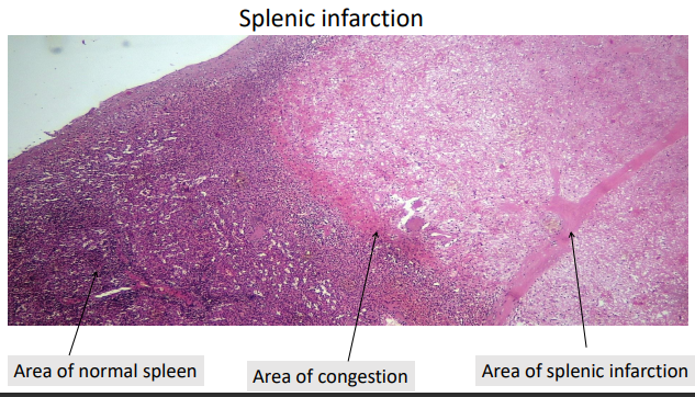 <p>splenic infarction </p><p>ischemia </p>