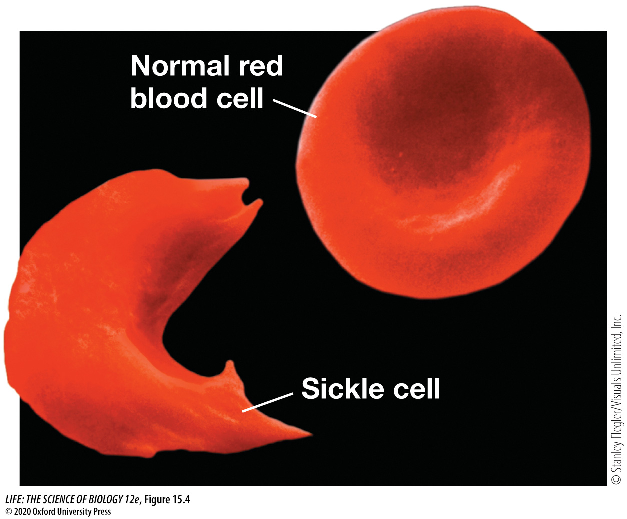 <p><strong><u>Abnormal Hemoglobin</u></strong></p><p>What causes Sickle-cell disease?<br><br><strong>Concept 15.2 Mutations in Humans Can Lead to Diseases</strong></p>
