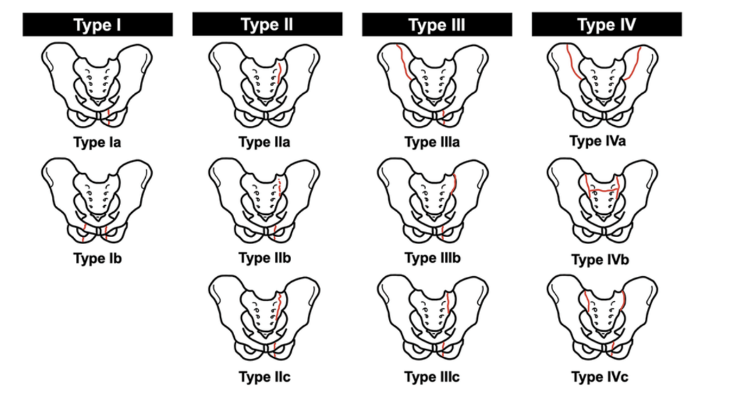 <ul><li><p>Reminder — pelvic bones, sacrum, &amp; associated joints form a bony ring surrounding the pelvic cavity — soft tissue &amp; organ damage is suspected when the pelvis is fractured</p></li><li><p>Patients with multiple injuries &amp; evidence of chest, abdominal, &amp; lower limb trauma should alos be investigated for pelvic trauma</p></li><li><p>Pelvic fractures can be associated with appreciable blood loss (concealed exsanguination) and blood transfusion is often required. Additionally, this bleeding tends to form a significant pelvic hematoma — can compress nerves, organs &amp; inhibit pelvic visceral function </p></li><li><p>Classification —</p><ul><li><p>Type 1 — don’t disrupt bony pelvis ring (ex. iliac crest fracture) — unlikely to represent significant trauma, though if iliac crest is fractures, blood loss needs to be assessed</p></li><li><p>Type 2 — a single break in bony pelvic ring (ex. single fracture with diastasis (separation) of the symphysis pubis) — again relatively benign, but should assess for blood loss</p></li><li><p>Type 3 — double breaks in bony pelvic ring, including bilateral fractures of pubic rami, which could cause urethral damage</p></li><li><p>Type 4 — occur at &amp; around the acetabulum </p></li></ul></li></ul>