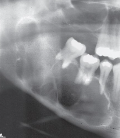 <ul><li><p>Central/solid/conventional</p></li><li><p>Unicystic</p></li><li><p>Peripheral (soft tissue)</p></li><li><p>Desmoplastic</p></li><li><p>Malignant (spreads)</p></li></ul><p></p>