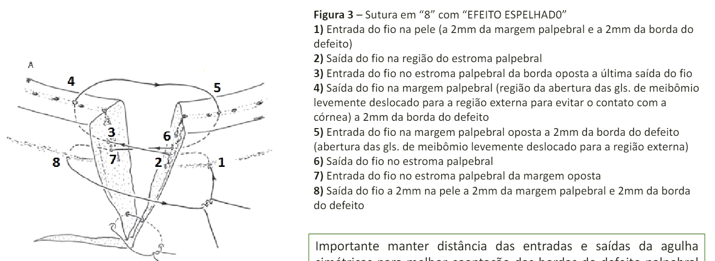 <p><strong><span style="color: blue">Neoformações em Anexos Oculares</span></strong></p><p><span style="color: blue">Técnica:</span></p><ol><li><p><span style="color: purple">Incisar a pele em “V” ou pentágono com cabo bisturi no 3 e15c;</span></p></li><li><p><span style="color: purple">Com tesoura, remover o fragmento na espessura total;</span></p></li><li><p><span style="color: purple">A sutura é realizada em 2 planos:</span></p><blockquote><ul><li><p><span style="color: green">Subcutâneo com ponto simples ou contínuo (absorvível 6.0);</span></p></li><li><p><span style="color: green">Pele: Ponto em “8” conforme esquema abaixo, com fio não absorvível 4.0 a 5.0 na margem seguido de pontos simples separados.</span></p></li></ul></blockquote></li></ol>
