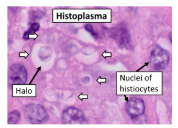 <p>Macrophages with yeast cells with halos </p>