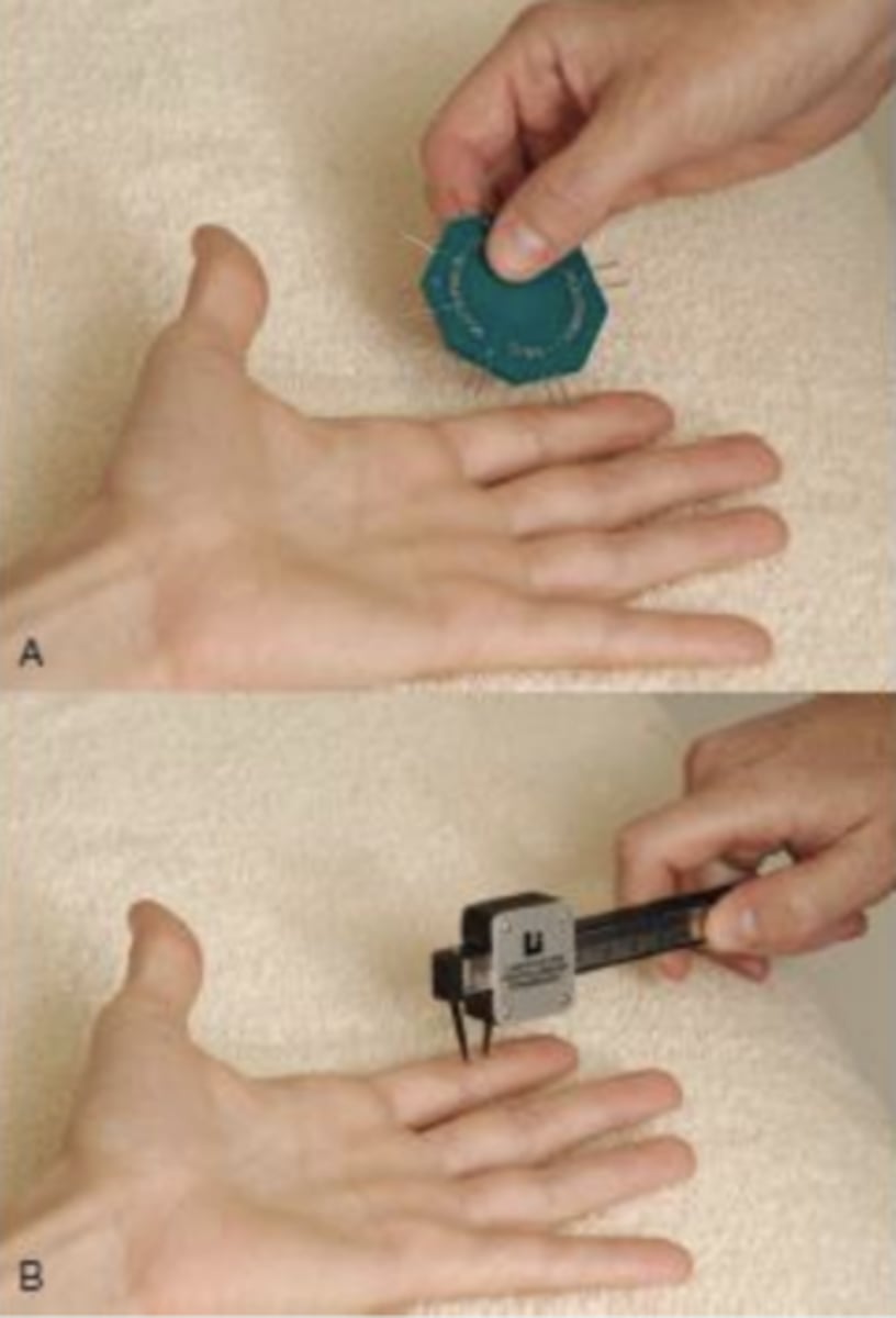 <p>- identify level of sensory innervation in hand</p><p>description: PT uses paper clip, two point discriminator or calipers to simultaneously apply pressure on two adjacent points in a longitudinal direction - or perpendicular to the long axis of the finger; the PT moves proximal to distal in an attempt to find the minimal distance at which the pt can distinguish between two stimuli</p><p>- only fingertips need to be test.</p><p>normal discrimination distance recognition is less than 6 mm.</p>