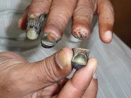 what type of gangrene is this?
